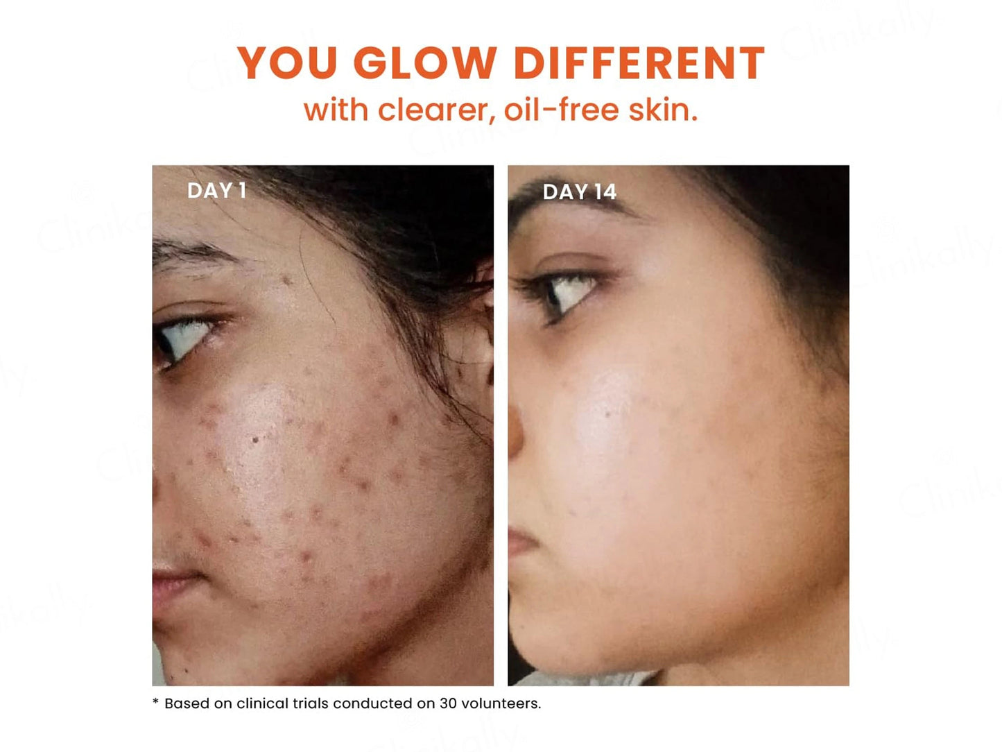 Foxtale 12 Percent Niacinamide Azelaic Acid Clarifying Serum