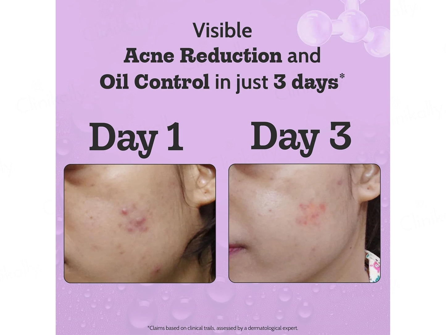Chemist At Play 2 Percent Salicylic Acid Acne Control Face Serum