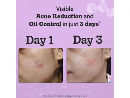 Chemist At Play 2 Percent Salicylic Acid Acne Control Face Serum