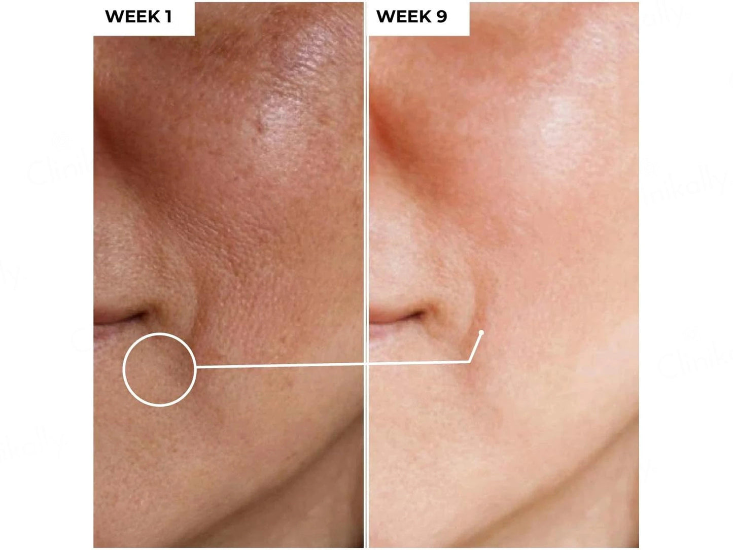 Dermabay 15 Percent Vitamin C  1 Percent Hyaluronic Acid Face Serum