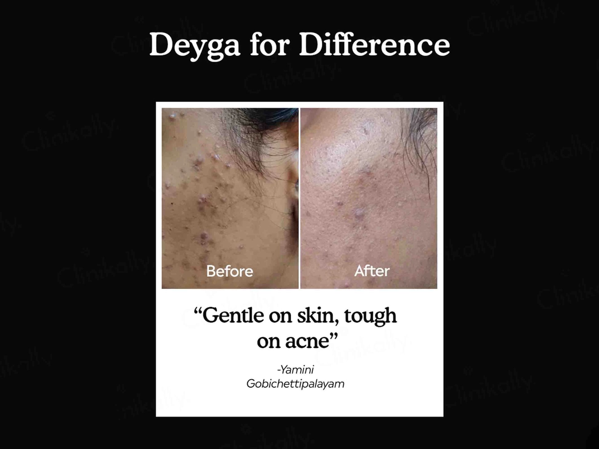 Deyga Charcoal Bath Bar For Acne Control and  De-Tan