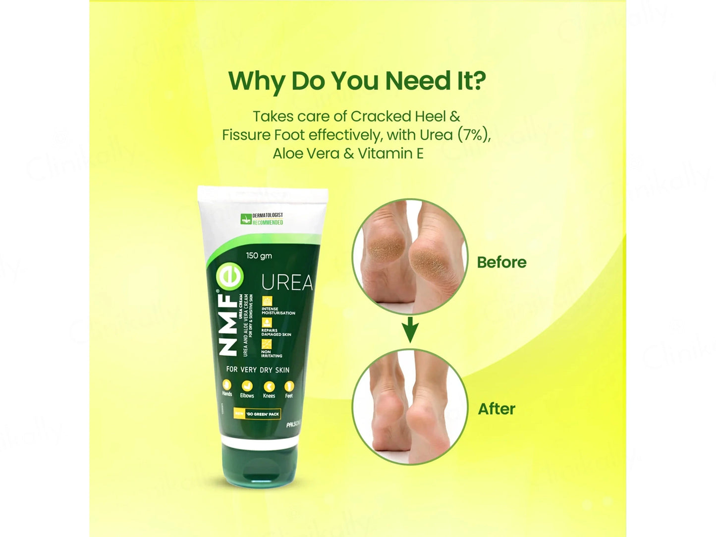 NMFe Urea and Aloe Vera Cream For Very Dry Skin