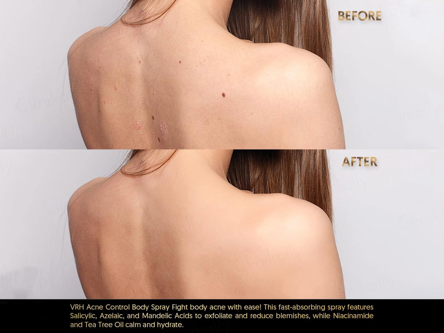 VRH Acne Clarify Therapy Body Spray